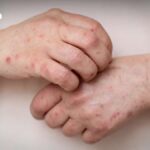 Mpox-Alarm in Thailand: Krankheitsfälle nach Songkran steigen an Mpox-Alarm: Behörden verstärken Kontrollen