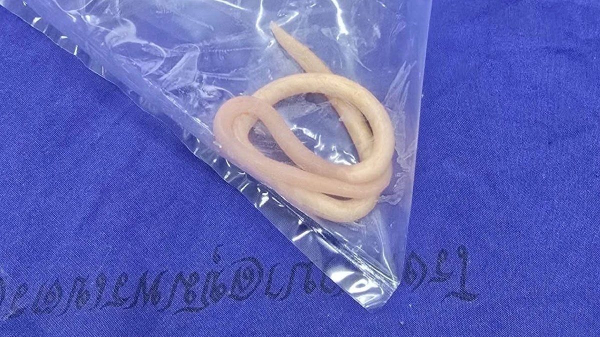 Schock-Moment in Klinik: Kleinkind erbricht lebende Parasiten
